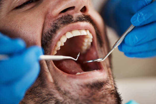 Best Wisdom Tooth Removal  in Rotan, TX